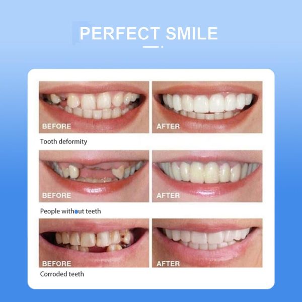 Snap-on Smile: Instant Confidence with a Brighter, Whiter Smile – Free Delivery!